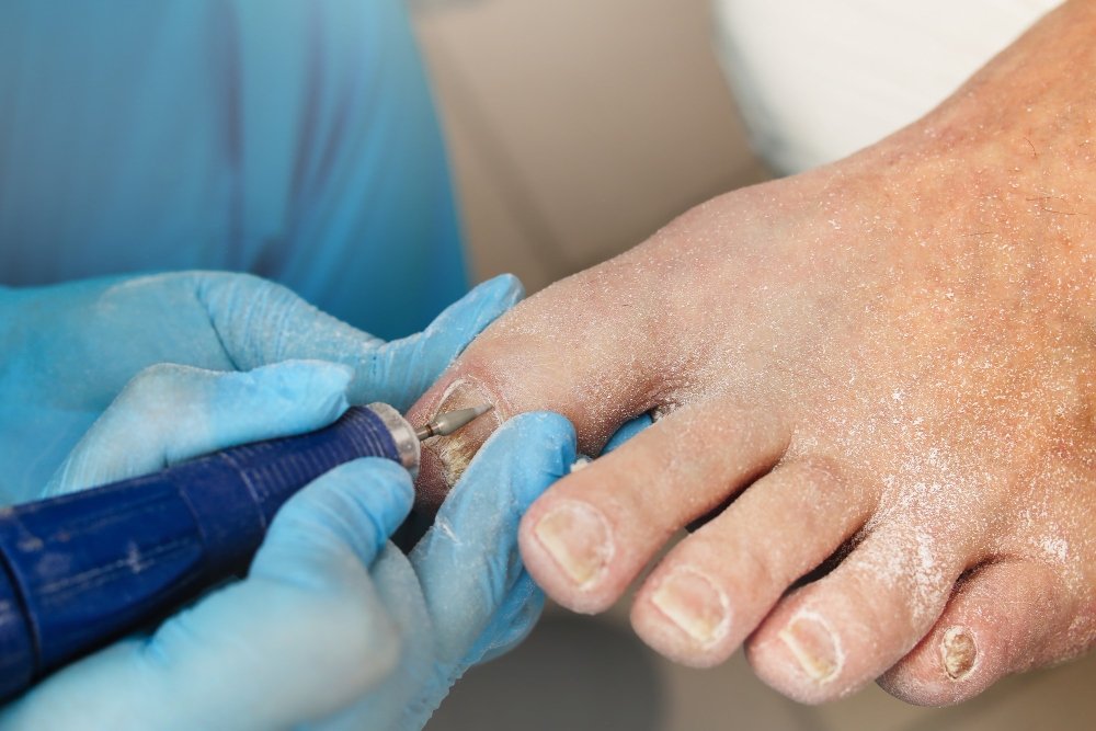 Conservative-Nail-Care-Non-Surgi