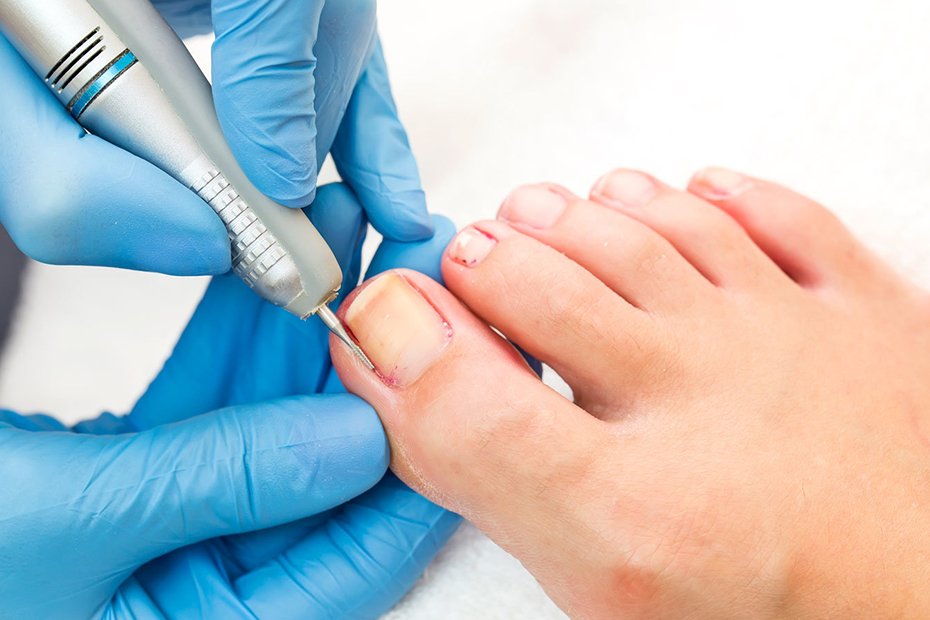 Nail-Surgery