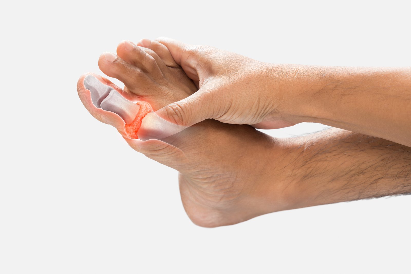 High levels of uric acid in men's toes bones on a gray background.
