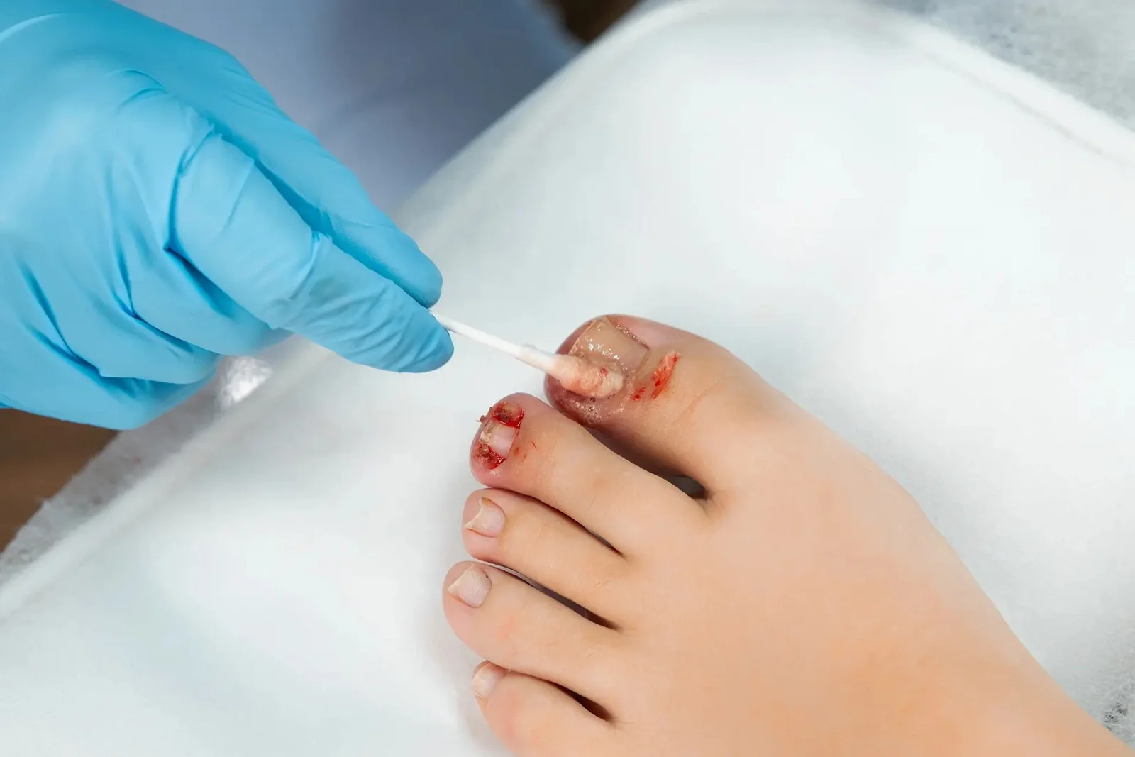 nail-bed-avulsion-treatment.jpg (1)